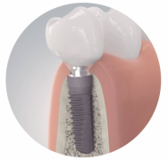 半口种植牙效果好不好？品牌抉择起关键作用